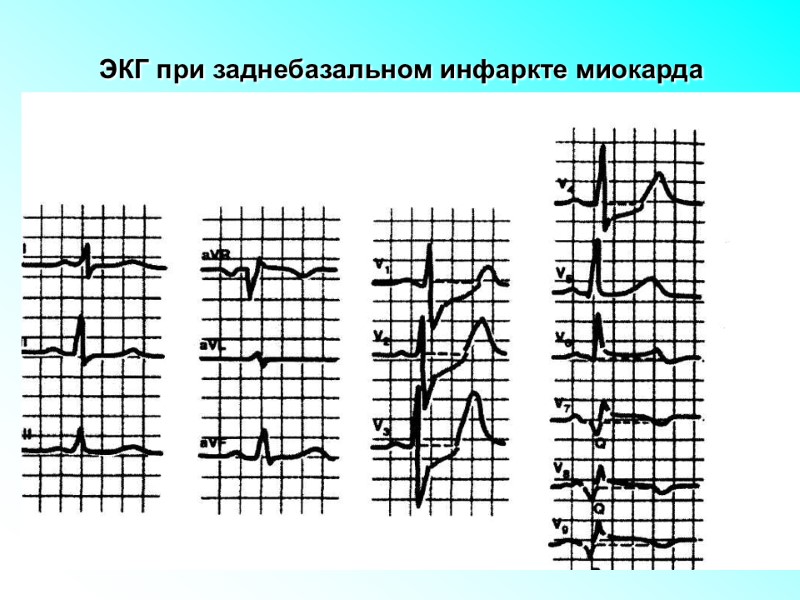 ЭКГ при заднебазальном инфаркте миокарда